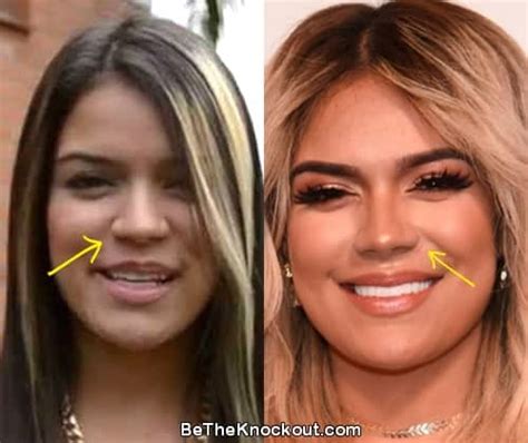 karol g nose job|Karol G: Embracing Beauty Changes with Plastic Surgery and。